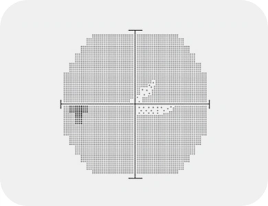 정상 시야검사